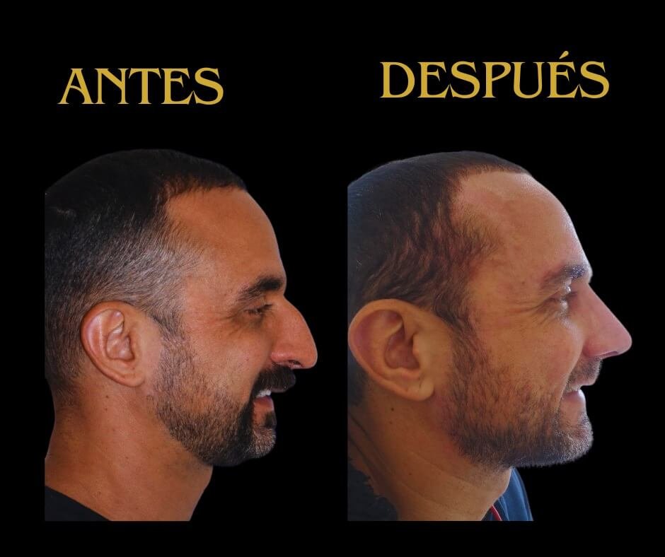 Rinoplastia caballero perfil derecho