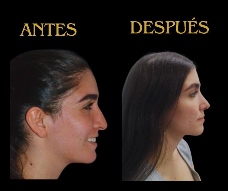 Lado derecho rinoplastia mujer