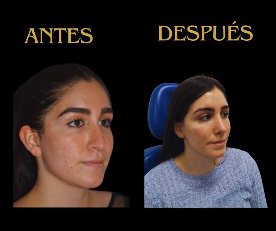 Mujer de perfil con rinoplastia 