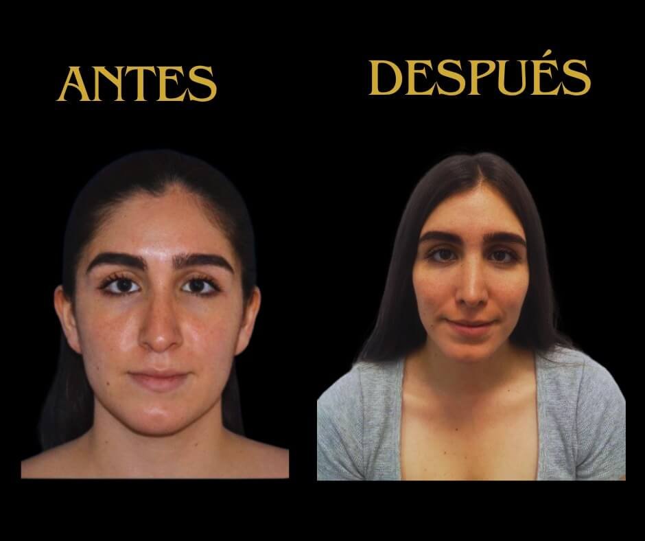 Mujer joven rinoplastia de frente