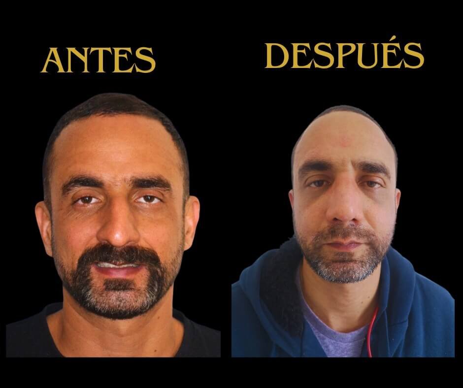 Perfil de frente rinoplastia hombre 