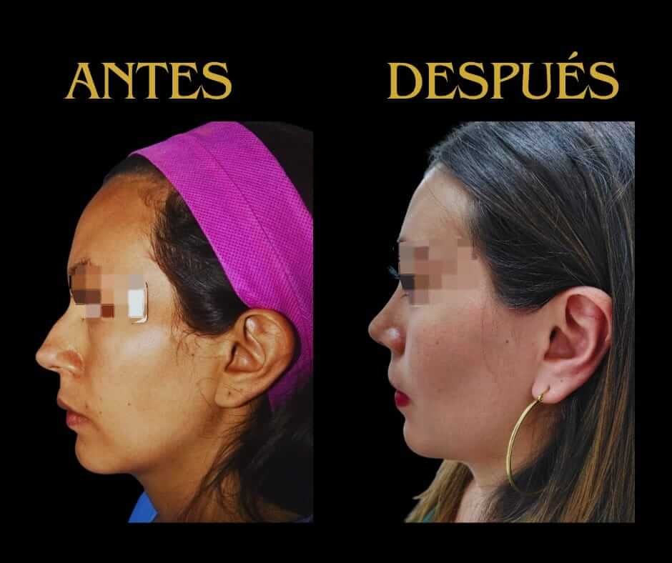 Perfil izquierdo otoplastia mujer