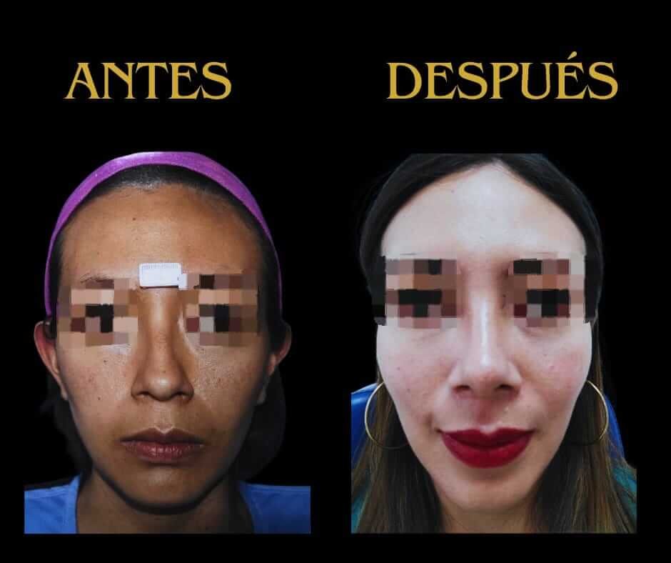 Perfil de frente otoplastia mujer