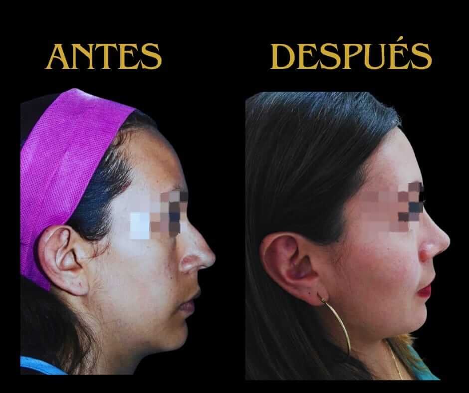 Otoplastia perfil derecho mujer