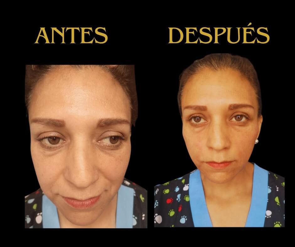 Perfil frontal aplicación ácido hialurónico mujer