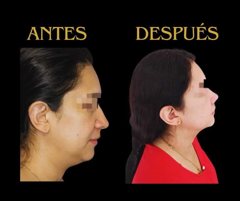 Perfil derecho lipopapada mujer