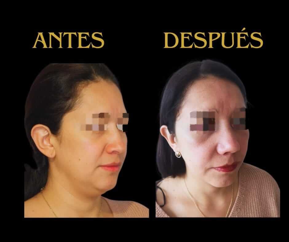 Lipopapada perfil izquierdo mujer