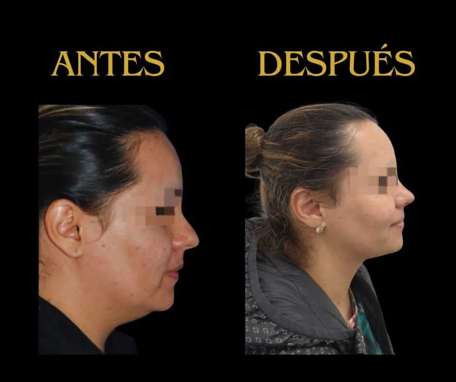 Perfil derecho lipopapada mujer